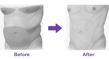 liposuction-3.png